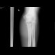 Fracture of foream bones: X-ray - Plain radiograph